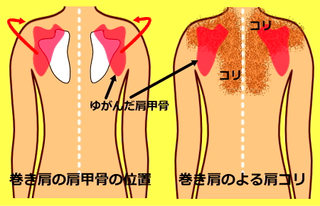 内巻き肩の絵図